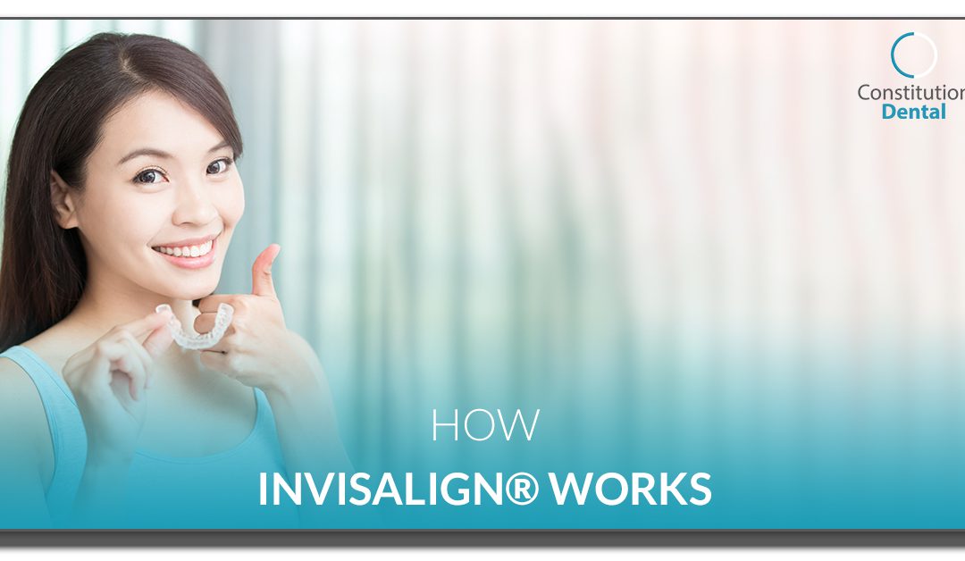 How Invisalign® Works