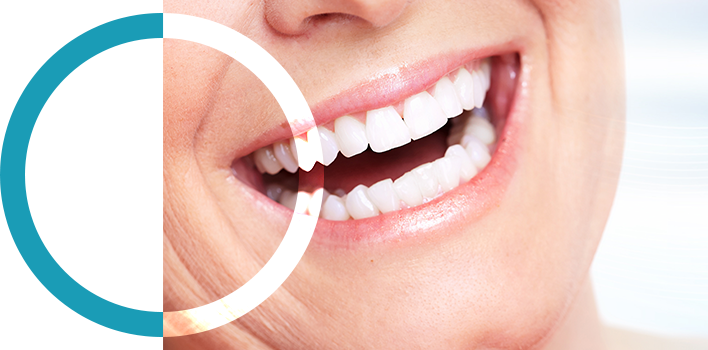 Teeth Whitening Ottawa Ottawa Teeth Whitening