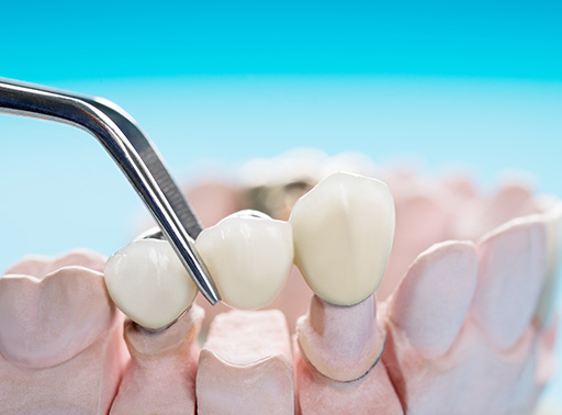 Dental Crowns White Tooth Crowns Ottawa