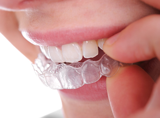 Invisalign Ottawa - Clear Braces Dentist in Downtown Ottawa