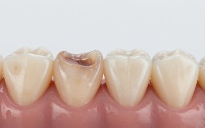 Stages of Tooth Decay: From Early Signs to Severe Damage
